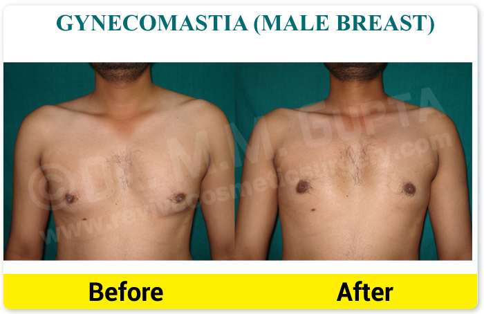 A to Z of Breast Fat Transfer By Dr. Amit Gupta  Pros and Cons of Breast  Fat Injection 